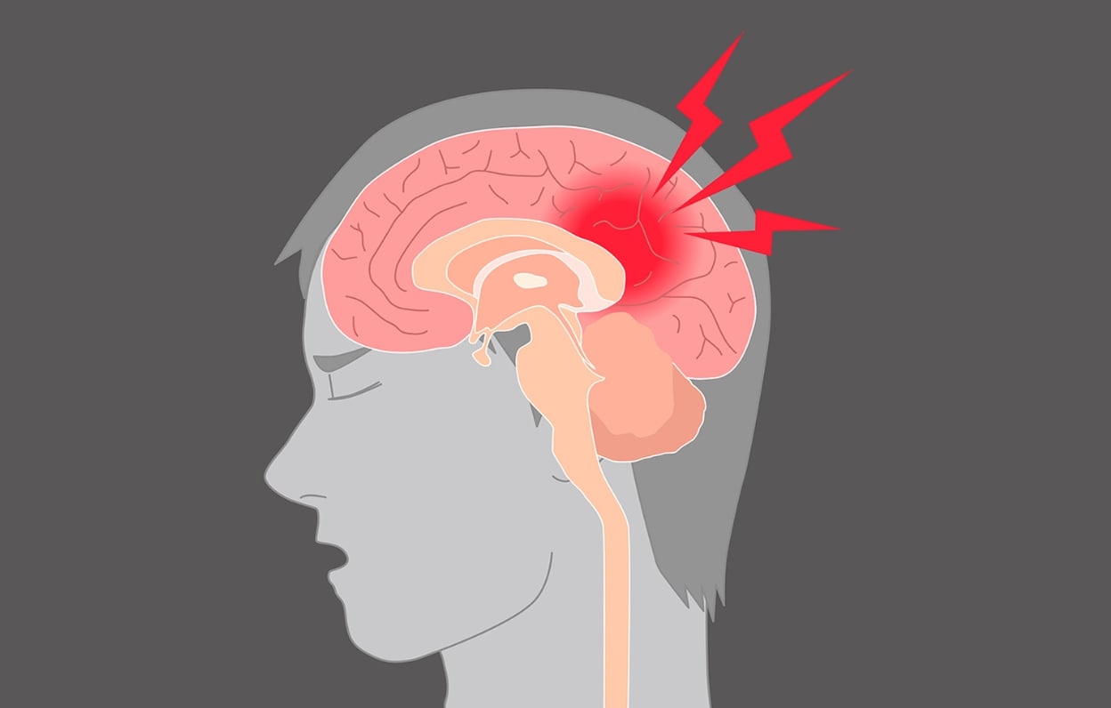 뇌진탕 관련 머리 속 뇌 부분이 빨갛게 되어 있는 그림