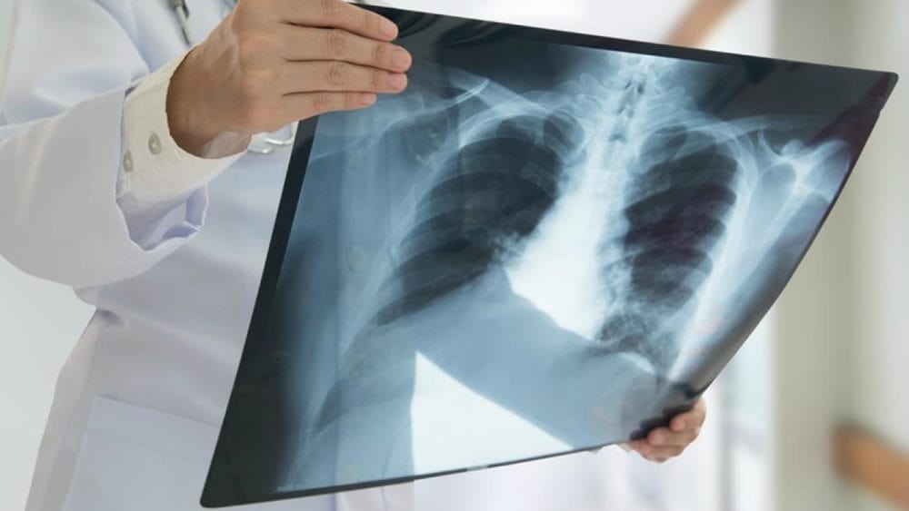 폐렴 관련 폐 엑스레이 사진을 보고 있는 의사 모습
