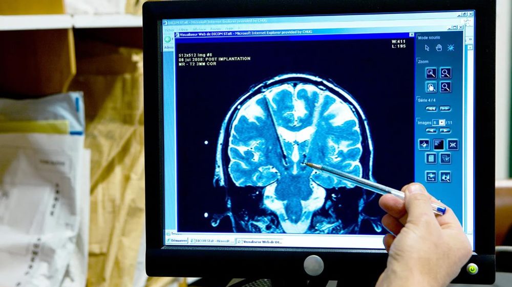간질 관련 뇌 부분 MRI 촬영 사진을 보고 있는 모습