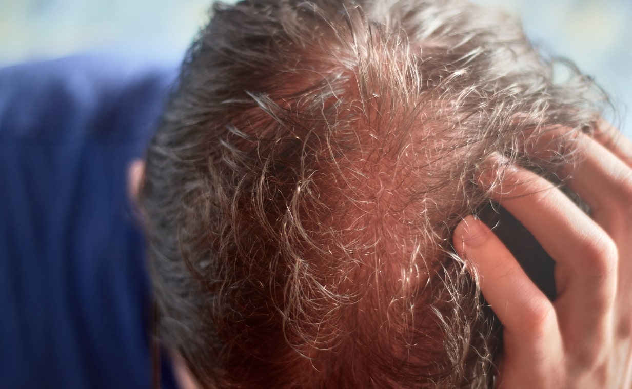 두피열 관련 노인의 머리 부근이 붉게 변해 있는 모습
