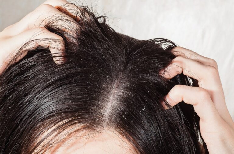 비듬 생기는 이유 관련 여성이 양 손으로 머리를 긁고 있고 머리에 비듬이 많이 보이는 모습