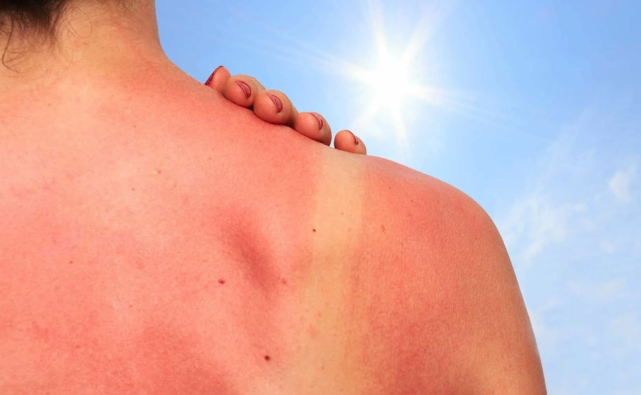 햇빛 알레르기 관련 햇빛 아래 등 쪽 피부가 빨갛게 변한 모습
