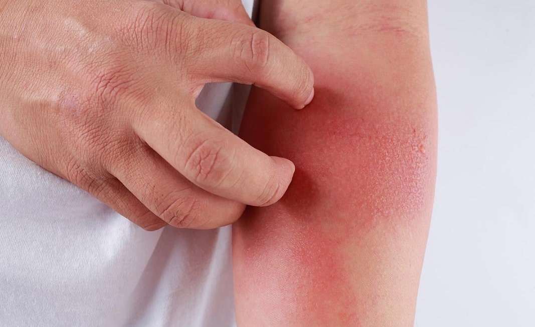 햇빛 알레르기 관련 팔 부분이 빨갛게 변해서 글고 있는 모습