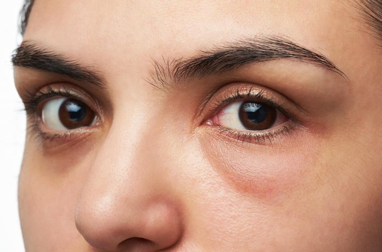 눈 밑 부음 증상 관련 오른쪽 눈 아랫 부분이 부어 있는 모습