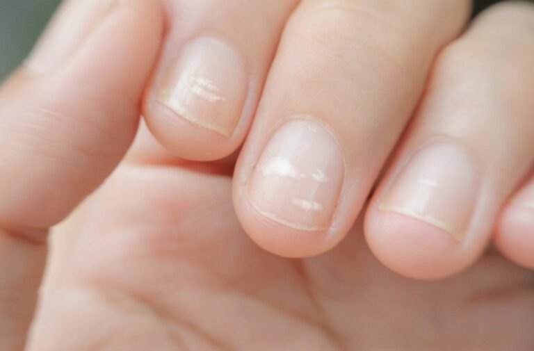 손톱에 하얀점 생기는 이유 포스팅 관련 손톱 부분에 하얀점이 있는 모습