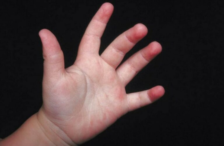 아기손 습진 관련 손가락 부분이 빨갛게 된 아기손 모습